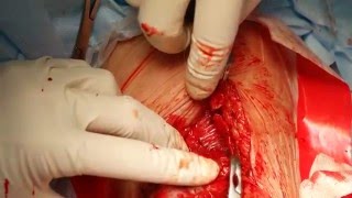 Резекция аневризм нативной артериовенозной фистулы.
