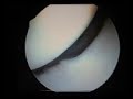 My Knee Arthroscopy