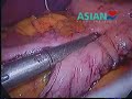 Sleeve gastrectomy for weight loss in India Sleeve gastrectomy for weight loss in India