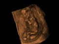 3d Ultrasound  fetus 13 weeks 3D T/V probe