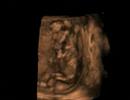 3d Ultrasound fetus 13 weeks 3D T/V probe