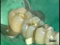 Dentsply - Xeno III Single Step
