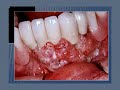 Video Lecture : Oral Lesions- The Most Common Mucosal Disorders