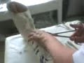 Taking off my cast
