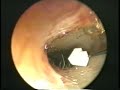 Medial tympanoplasty