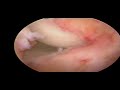 Arthroscopic Knee Surgery Arthroscopic Knee Surgery
