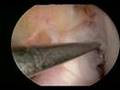 Arthroscopic Knee Surgery