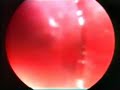metastasi pleuriche, biopsia in toracoscopia