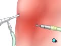 Malpractice Medical Anterior Cruciate Ligament Arthroscopic Repair Surgery 3