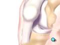 Malpractice Medical Anterior Cruciate Ligament Arthroscopic Repair Surgery 3