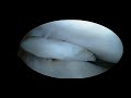 Partial medial meniscectomy Partial medial meniscectomy