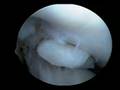 Partial medial meniscectomy