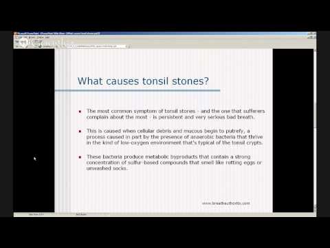 how to treat tonsil stones