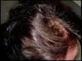 Can you stop hair loss and regrow your hair naturally