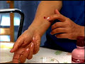 How to Treat Insect Bites & Stings : How to Reduce the Swelling of an Insect Bite How to Treat Insect Bites & Stings : How to Reduce the Swelling of an Insect Bite
