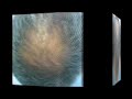 Beard - Facial hair transplantation by FUE to bald crown