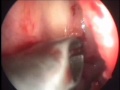 MIST is minimally invasive Sinus surgery done for isolated maxillary sinus pathology which is better than ballon sinuplasty.