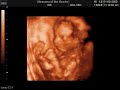Amazing 3D 4D Ultrasound 19 weeks pregnant - Baby Girl - Lilah