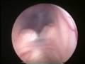 Drainage Of the Third Ventricle Using Endoscopic Method Drainage Of the Third Ventricle Using Endoscopic Method