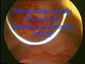 Endometrial Polip (Rahim içinde polip) Endometrial Polip (Rahim içinde polip)