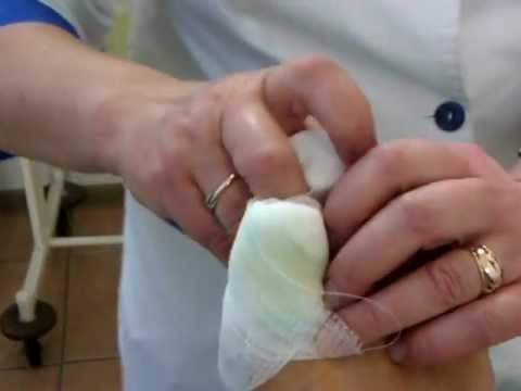 Как перевязывать палец после удаления ногтя Как перевязывать палец после удаления ногтя