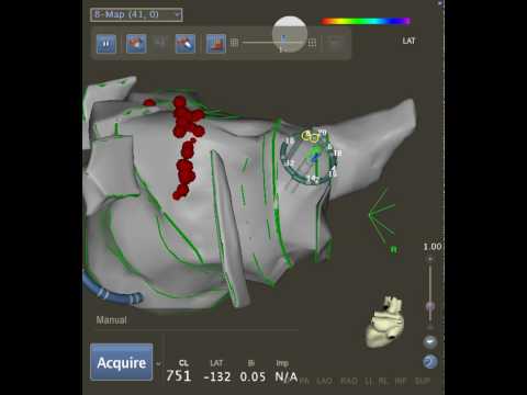 Fast Anatomical Map: Carto 3