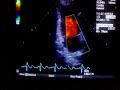 Echocardiography Echocardiography