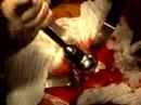On Thursday, February 8, 2006 at 8 p.m. EST, join NewYork-Presbyterian Hospital orthopedic surgeons Drs. William B. Macaulay and Jeffrey A. Geller for a web cast discussion on total hip resurfacing. The doctors will show highlights from an actual total hip resurfacing surgery, discuss the procedure and its promise as an alternative to total hip replacement, and engage in a live question and answer session with audience members.Dr. Macaulay trained under Drs. Derek McMinn and Ronan Treacy, the Birmingham, England-based orthopedic surgeons who developed the implant for total hip resurfacing.