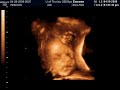 Twins at 28 weeks, 3D ultrasound in color, part 4