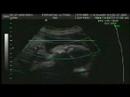 Baby Pisetsky