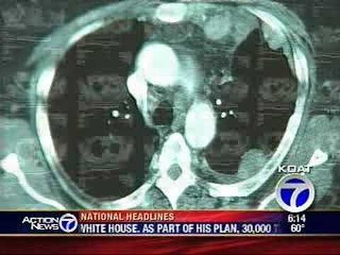 Healthbeat - Lung Cancer