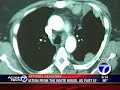 Healthbeat - Lung Cancer