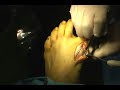 Austin Bunionectomy with Internal Fixation Part 1
