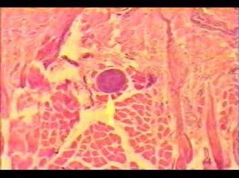 Section of Sarcocystis-infected deer ...