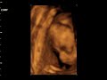 Dzaky Mom 6 Month Pregnant   4 Dimension UltraSonoGraphy 8 Ultrasonography