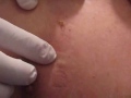 My Dads Cyst!