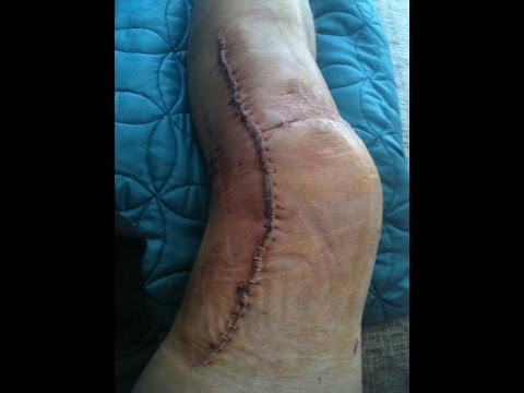 how to rebuild knee ligaments