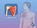 PreOp® Patient Education: Rotator Cuff Repair Open Surgery