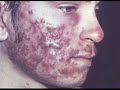 Pukey Pus Packed Pimples