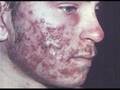 Pukey Pus Packed Pimples