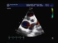 pulmonary hypertension jinay pulmonary hypertension jinay