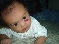 LOWER LEFT-EYE HEMANGIOMA
