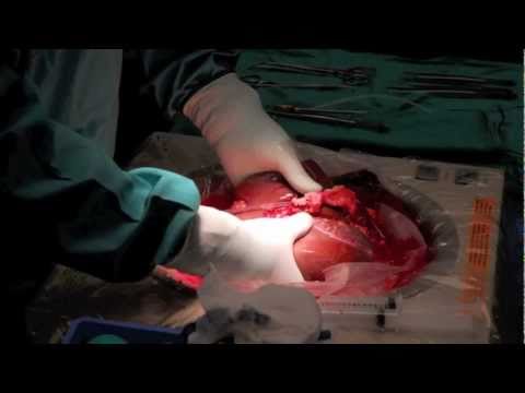 how to transplant liver