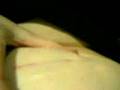 Morphine withdrawls.Neurostimulation Implant