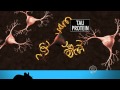 Discovery may lead to Alzheimer's treatments