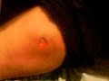 Cleaning Gunshot Wound 1 of 3