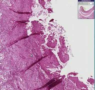 Histopathology Trachea--Diphtheria