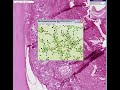 Histopathology Trachea--Diphtheria