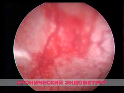 Хронический эндометриоз что это и как лечить Хронический эндометриоз что это и как лечить