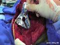 Total Scapula Prosthesis Ewing\